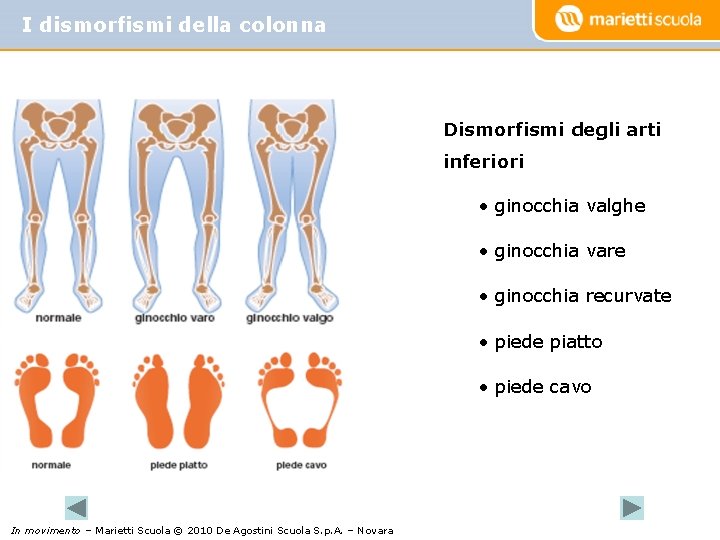 I dismorfismi della colonna Dismorfismi degli arti inferiori • ginocchia valghe • ginocchia vare