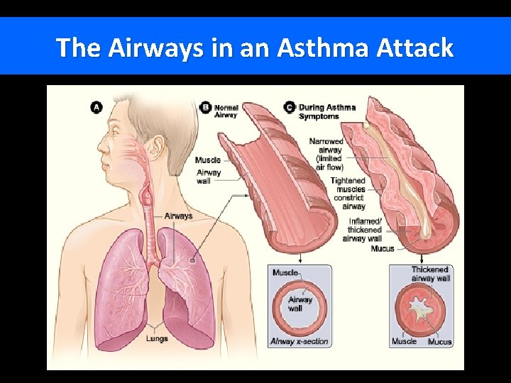 The Airways in an Asthma Attack 