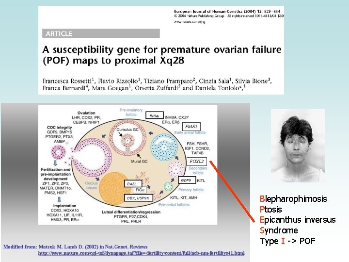 Blepharophimosis Ptosis Epicanthus inversus Syndrome Type I -> POF 