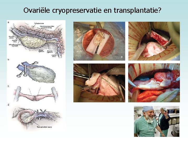 Ovariële cryopreservatie en transplantatie? 