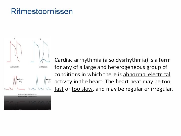 Ritmestoornissen Cardiac arrhythmia (also dysrhythmia) is a term for any of a large and