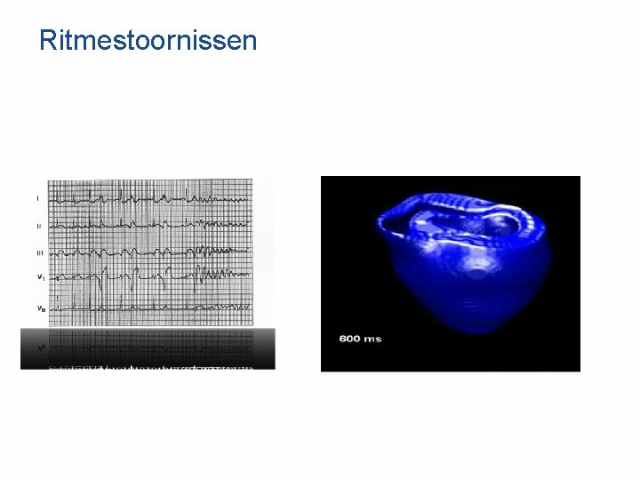 Ritmestoornissen 