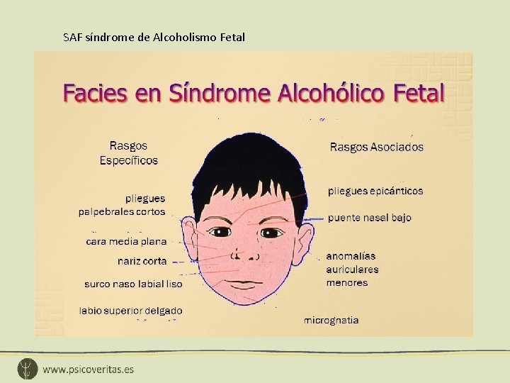 SAF síndrome de Alcoholismo Fetal 