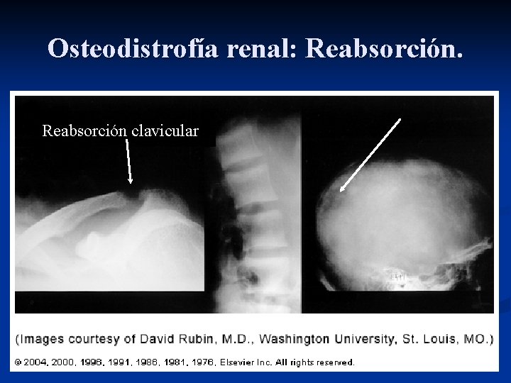 Osteodistrofía renal: Reabsorción clavicular Osteodistrofía renal: Reabsorción clavicular