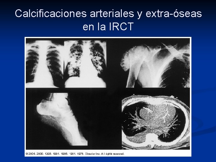 Calcificaciones arteriales y extra-óseas en la IRCT Calcificaciones arteriales y extra-óseas en la IRCT