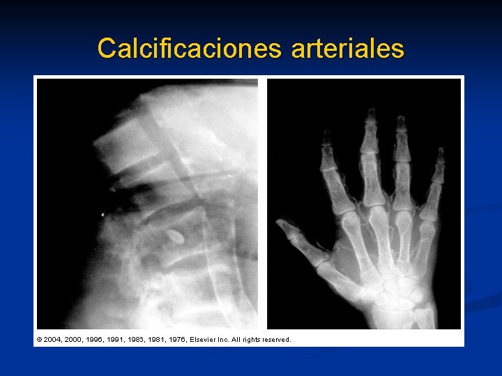 Calcificaciones arteriales Calcificaciones arteriales