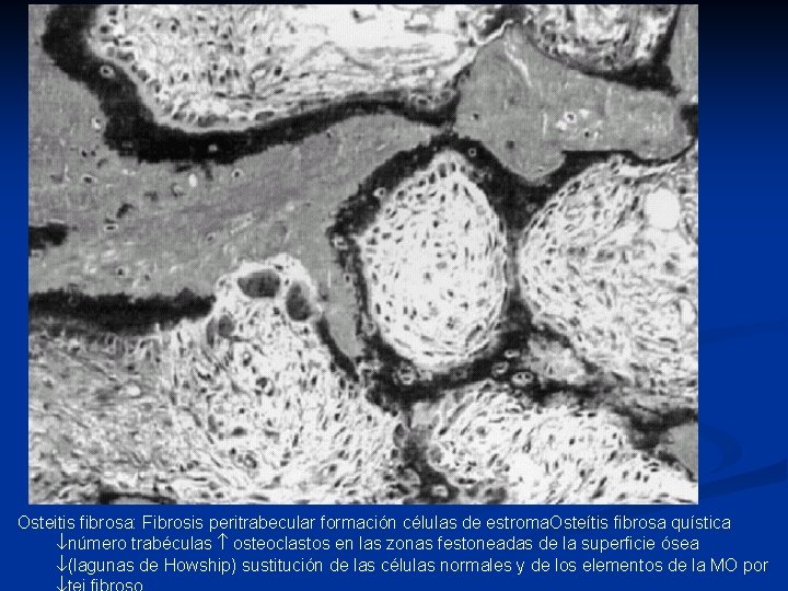 Osteitis fibrosa: Fibrosis peritrabecular formación células de estroma. Osteítis fibrosa quística número trabéculas osteoclastos Osteitis fibrosa: Fibrosis peritrabecular formación células de estroma. Osteítis fibrosa quística número trabéculas osteoclastos