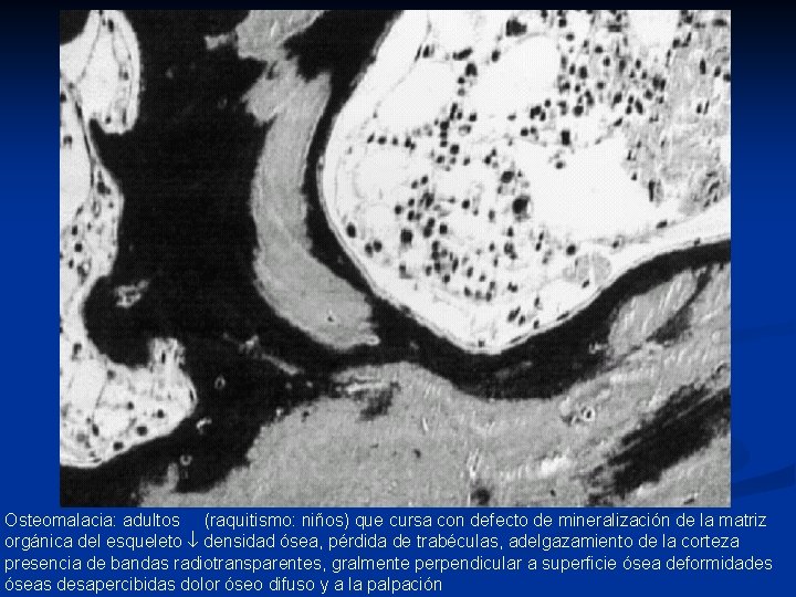 Osteomalacia: adultos (raquitismo: niños) que cursa con defecto de mineralización de la matriz orgánica Osteomalacia: adultos (raquitismo: niños) que cursa con defecto de mineralización de la matriz orgánica