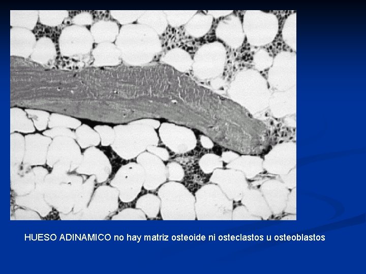 HUESO ADINAMICO no hay matriz osteoide ni osteclastos u osteoblastos HUESO ADINAMICO no hay matriz osteoide ni osteclastos u osteoblastos
