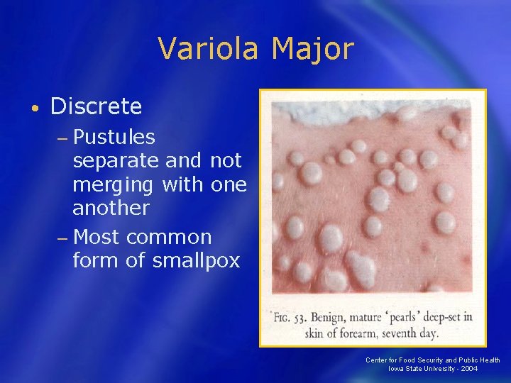 Variola Major • Discrete − Pustules separate and not merging with one another −