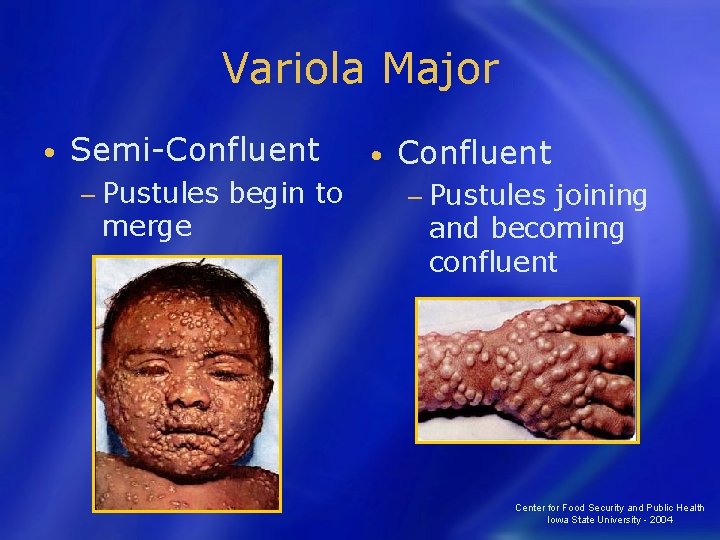 Variola Major • Semi-Confluent − Pustules merge begin to • Confluent − Pustules joining