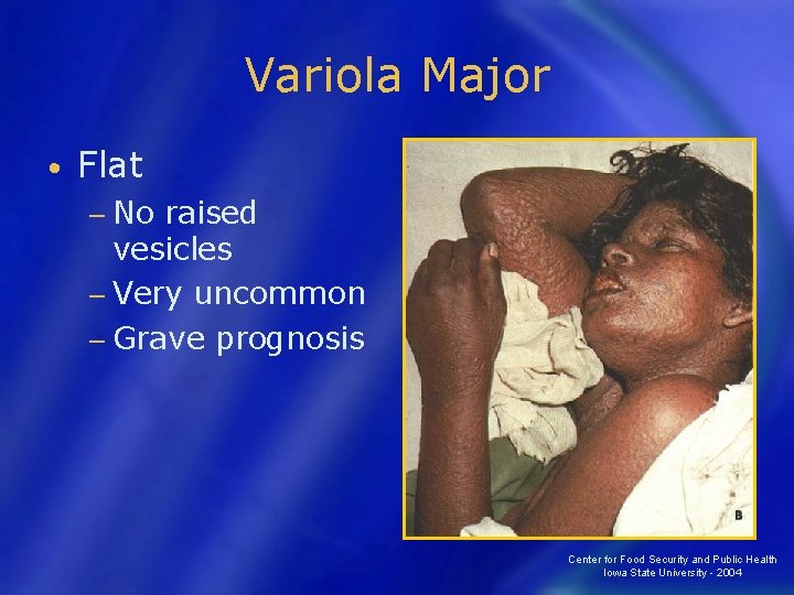 Variola Major • Flat − No raised vesicles − Very uncommon − Grave prognosis