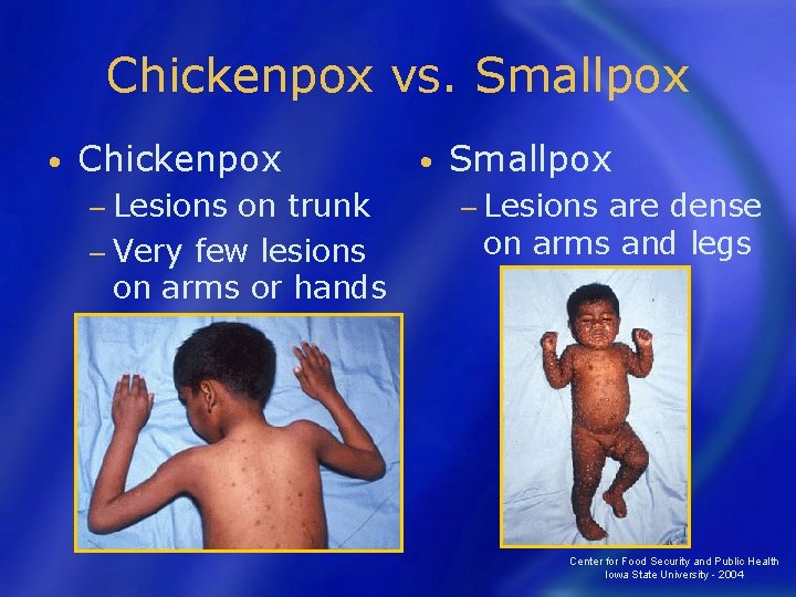 Chickenpox vs. Smallpox • Chickenpox − Lesions on trunk − Very few lesions on