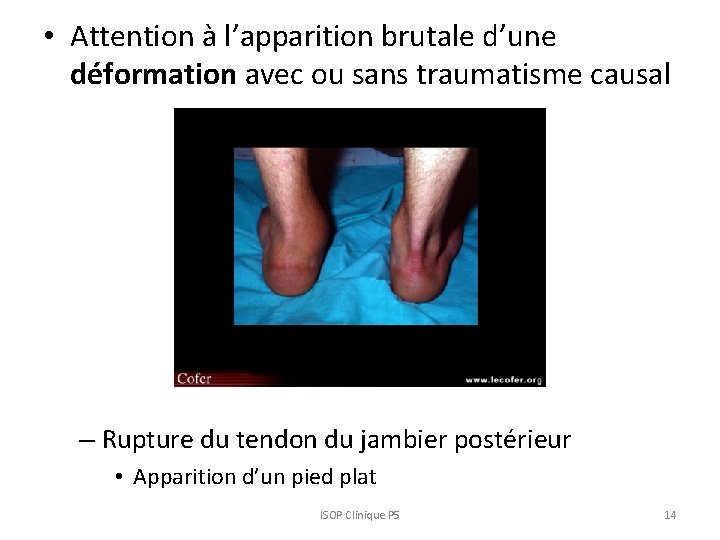 • Attention à l’apparition brutale d’une déformation avec ou sans traumatisme causal – • Attention à l’apparition brutale d’une déformation avec ou sans traumatisme causal –