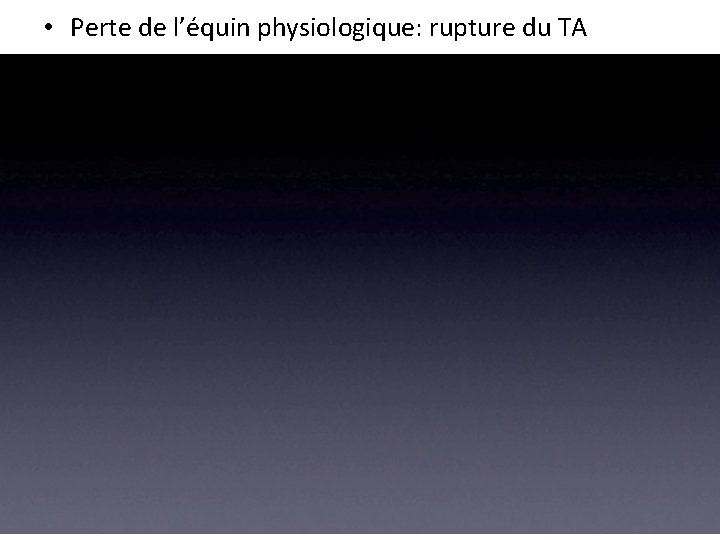 • Perte de l’équin physiologique: rupture du TA • Perte de l’équin physiologique: rupture du TA