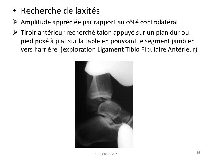 • Recherche de laxités Ø Amplitude appréciée par rapport au côté controlatéral Ø • Recherche de laxités Ø Amplitude appréciée par rapport au côté controlatéral Ø
