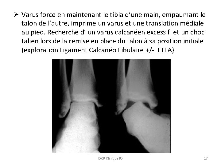 Ø Varus forcé en maintenant le tibia d’une main, empaumant le talon de l’autre, Ø Varus forcé en maintenant le tibia d’une main, empaumant le talon de l’autre,