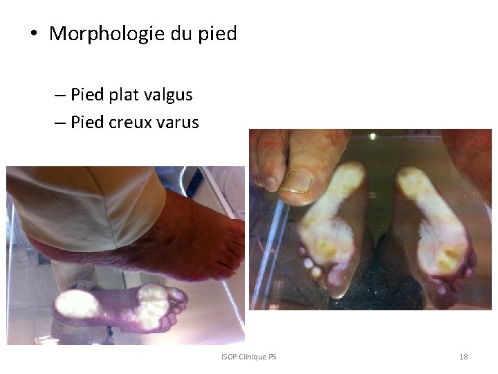 • Morphologie du pied – Pied plat valgus – Pied creux varus ISOP • Morphologie du pied – Pied plat valgus – Pied creux varus ISOP