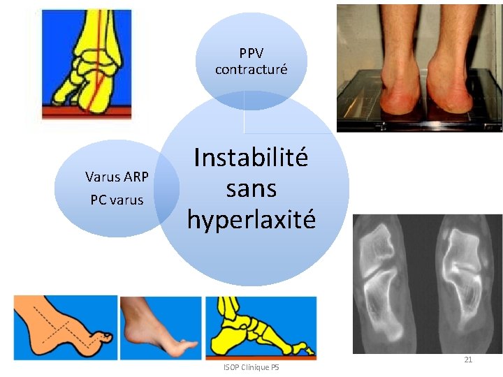 PPV contracturé Varus ARP PC varus Instabilité sans hyperlaxité ISOP Clinique P 5 21 PPV contracturé Varus ARP PC varus Instabilité sans hyperlaxité ISOP Clinique P 5 21
