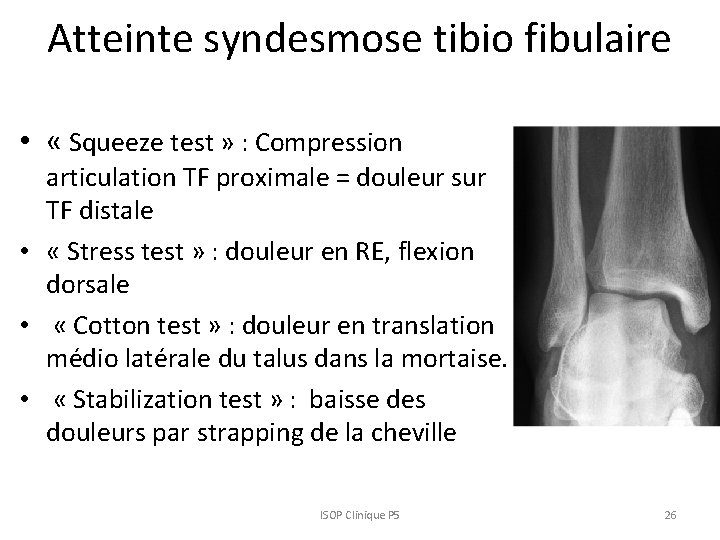 Atteinte syndesmose tibio fibulaire • « Squeeze test » : Compression articulation TF proximale Atteinte syndesmose tibio fibulaire • « Squeeze test » : Compression articulation TF proximale