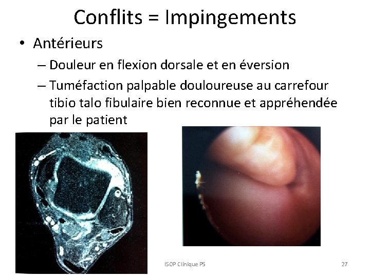 Conflits = Impingements • Antérieurs – Douleur en flexion dorsale et en éversion – Conflits = Impingements • Antérieurs – Douleur en flexion dorsale et en éversion –