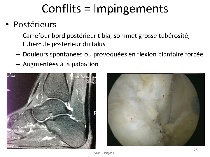 Conflits = Impingements • Postérieurs – Carrefour bord postérieur tibia, sommet grosse tubérosité, tubercule Conflits = Impingements • Postérieurs – Carrefour bord postérieur tibia, sommet grosse tubérosité, tubercule