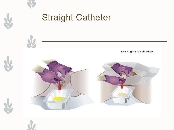 Straight Catheter 