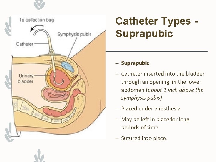 Catheter Types Suprapubic – Catheter inserted into the bladder through an opening in the