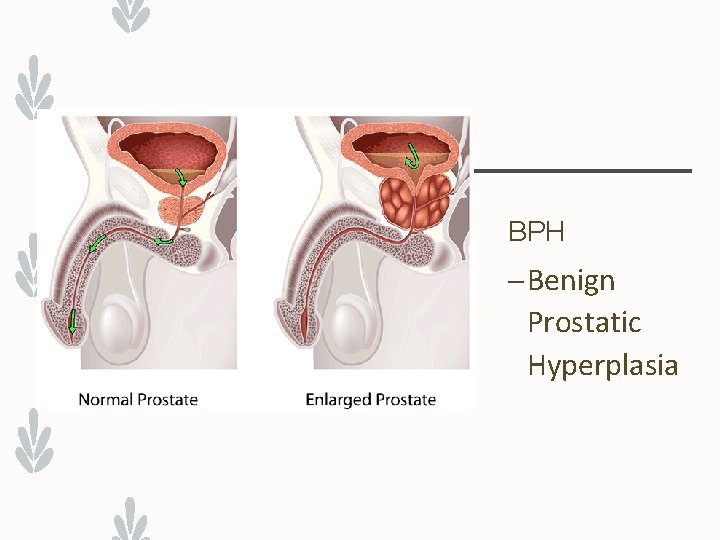 BPH – Benign Prostatic Hyperplasia 