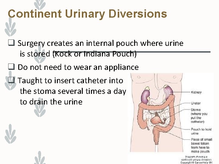 Continent Urinary Diversions q Surgery creates an internal pouch where urine is stored (Kock