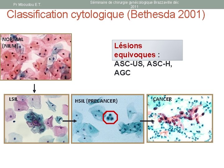 Pr Mboudou E. T. Séminaire de chirurgie gynécologique Brazzaville déc 2011 Classification cytologique (Bethesda