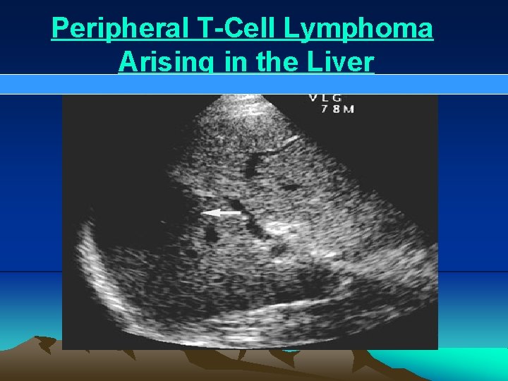 Peripheral T-Cell Lymphoma Arising in the Liver 