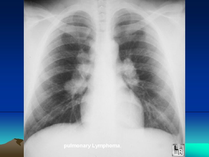 pulmonary Lymphoma. 