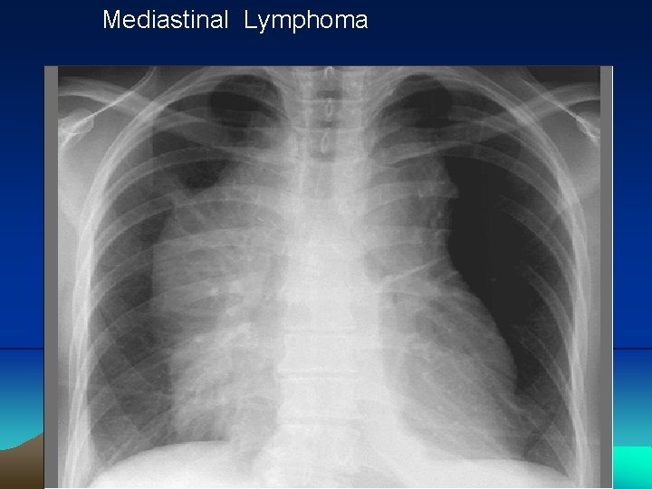 Mediastinal Lymphoma 