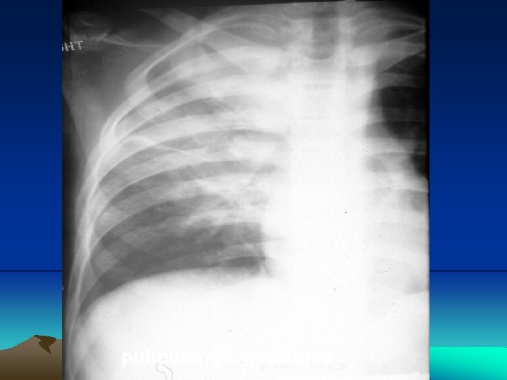 pulmonary Lymphoma. 