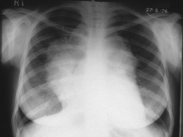 Mediastinal Lymphoma 