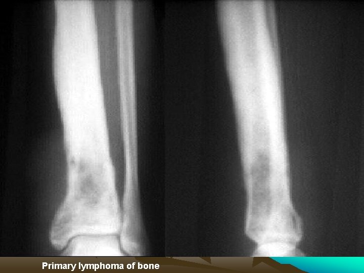  Primary lymphoma of bone 