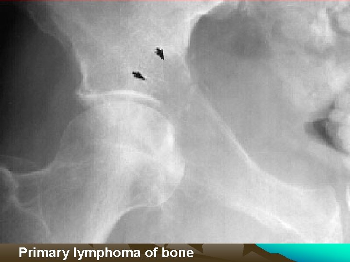  Primary lymphoma of bone 