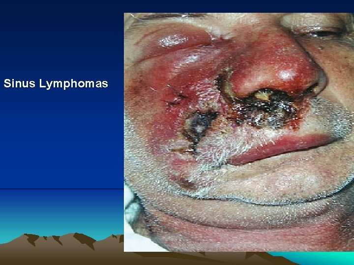 Sinus Lymphomas 