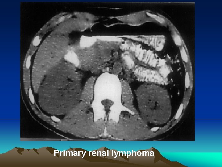 Primary renal Iymphoma 