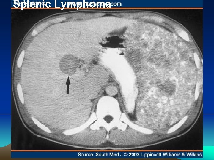 Splenic Lymphoma 