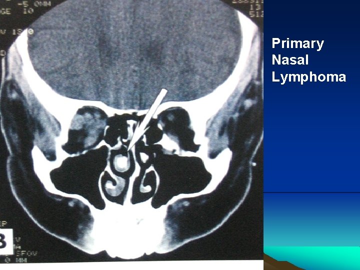 Primary Nasal Lymphoma 