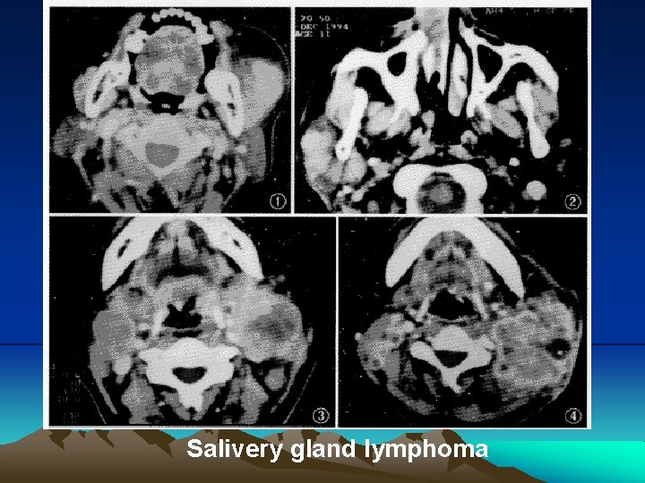 Salivery gland lymphoma 