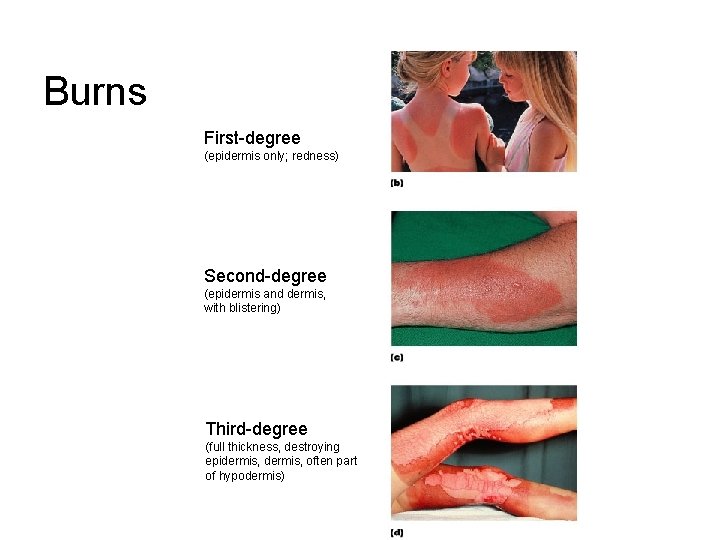 Burns First-degree (epidermis only; redness) Second-degree (epidermis and dermis, with blistering) Third-degree (full thickness,