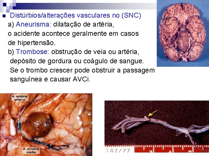 Distúrbios/alterações vasculares no (SNC) a) Aneurisma: dilatação de artéria, o acidente acontece geralmente em