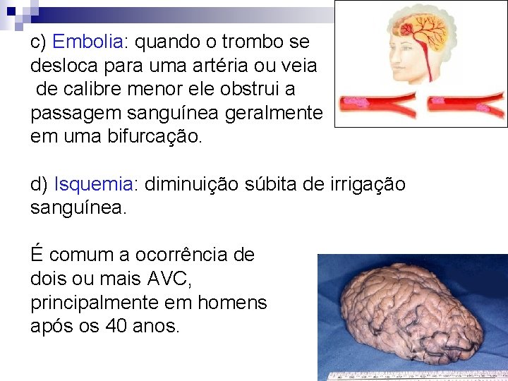 c) Embolia: quando o trombo se desloca para uma artéria ou veia de calibre