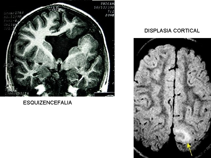 DISPLASIA CORTICAL ESQUIZENCEFALIA 