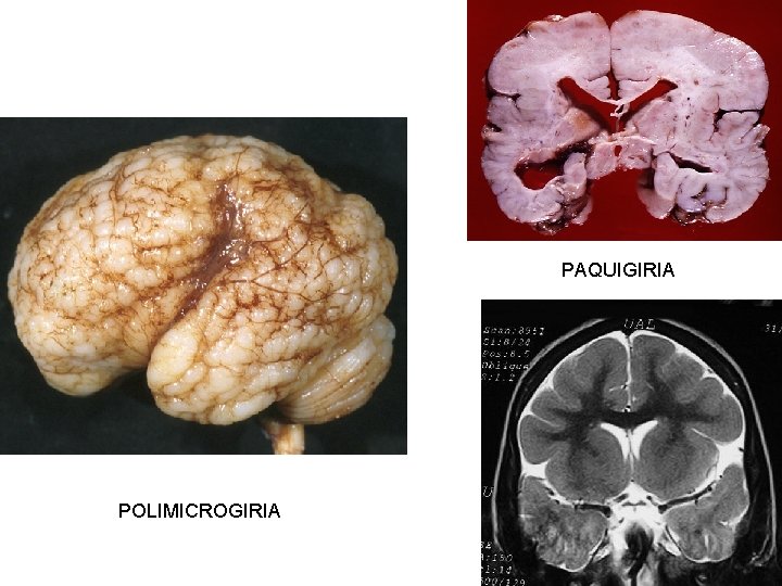 PAQUIGIRIA POLIMICROGIRIA 