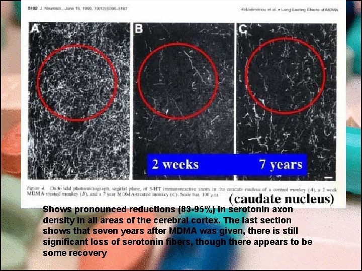 Shows pronounced reductions (83 -95%) in serotonin axon density in all areas of the