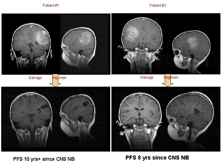 Patient #1: Salvage Regimen PFS 10 yrs+ since CNS NB Patient #2: Salvage Regimen